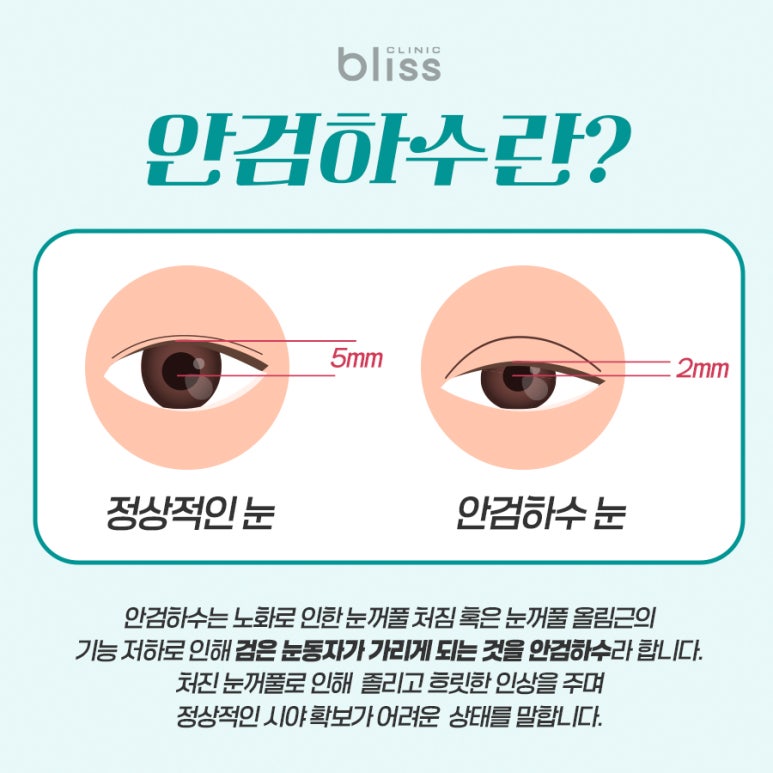 안검하수교정 성공을 위해 고려해야 하는 부분은 관련 이미지 2