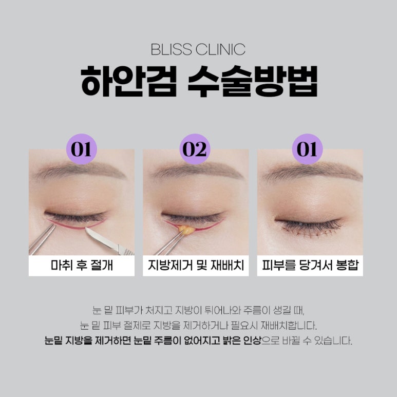 눈처짐 개선 상안검 하안검 수술 차이 살펴봐야 할 부분은 관련 이미지 4