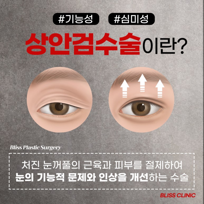 처진 눈꺼풀 올리기 상안검수술 후기 관련 이미지 2