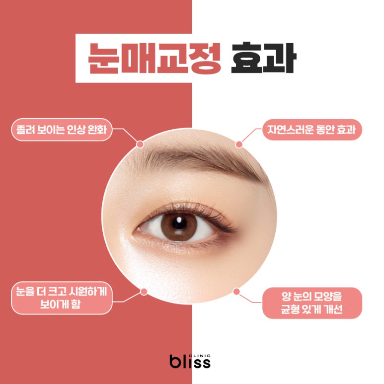 졸려 보이는 눈? 시원하고 또렷한 눈매 만드는 눈매교정 가이드 관련 이미지 3