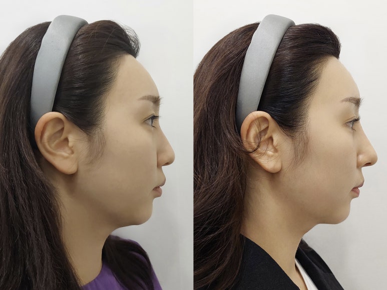 블리스의원 수능이벤트, 수험생을 위한 특별한 응원 선물 최대 30% 할인 관련 이미지 6