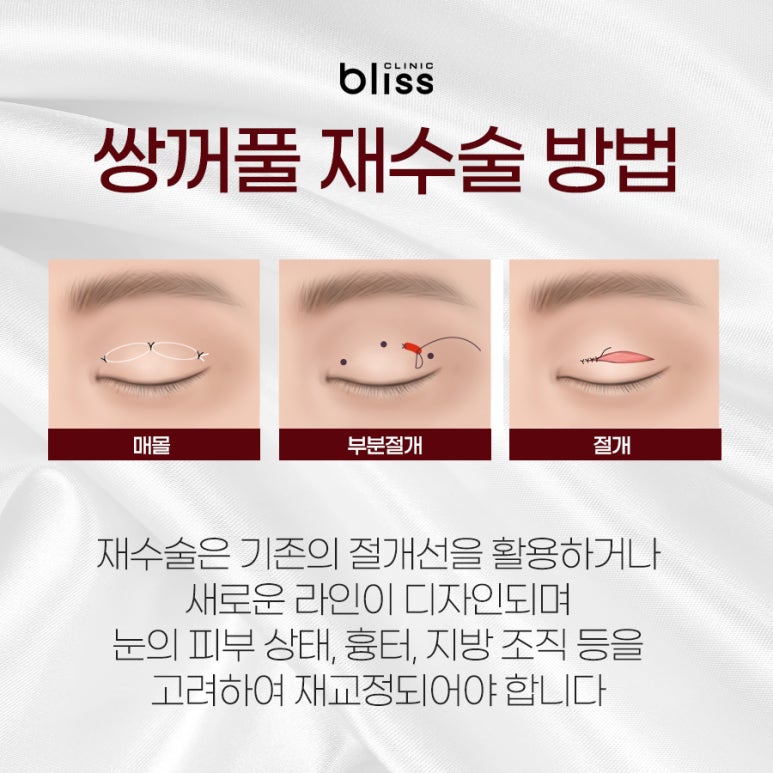 쌍꺼풀 재수술 방법 이전 수술의 실패 원인 파악이 우선 관련 이미지 5