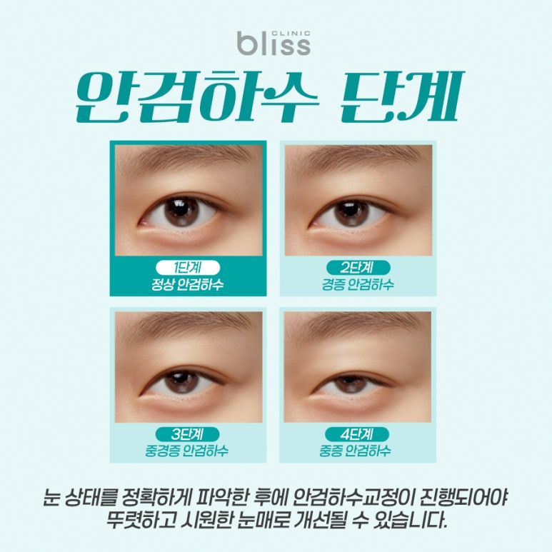 안검하수교정 성공을 위해 고려해야 하는 부분은 관련 이미지 3