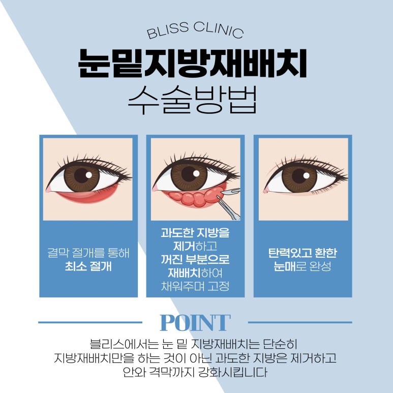 눈밑지방재배치 통증 수술 후 언제까지 관련 이미지 3