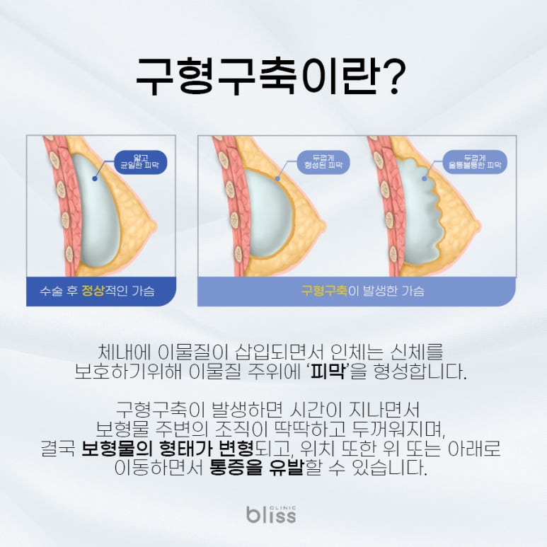 가슴 구형구축 재수술 받게 될 확률 관련 이미지 2