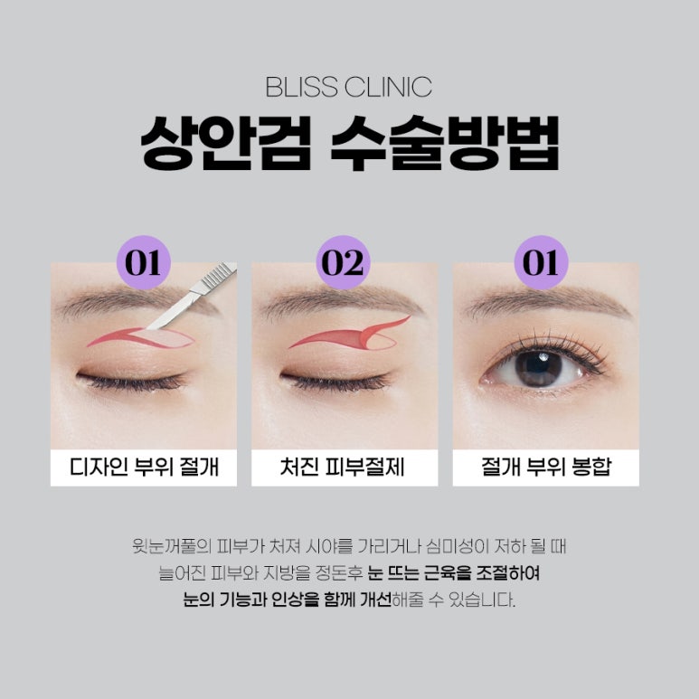 눈처짐 개선 상안검 하안검 수술 차이 살펴봐야 할 부분은 관련 이미지 3