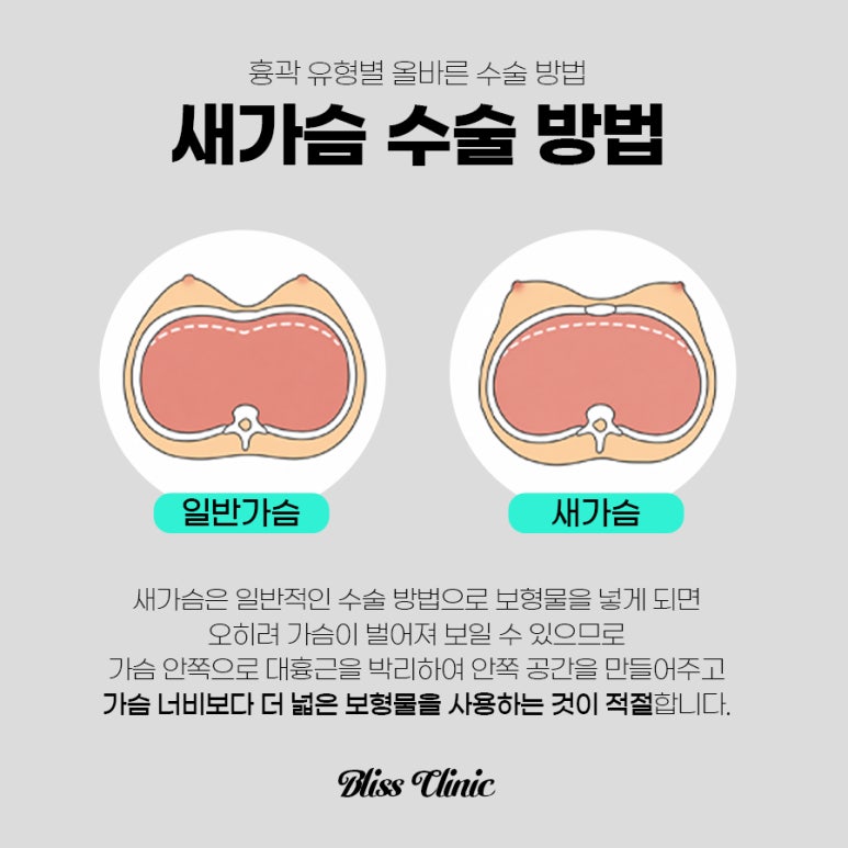오목가슴 새가슴 성공적인 가슴 성형을 위한 맞춤 솔루션 관련 이미지 3