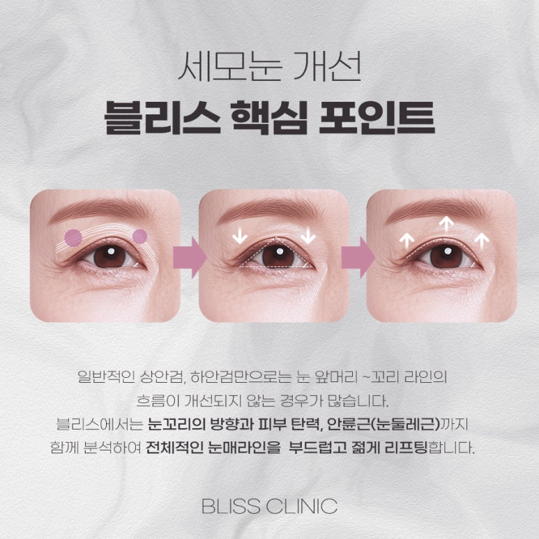 사나운 눈매로 보이는 세모눈 원인과 교정 방법 관련 이미지 4