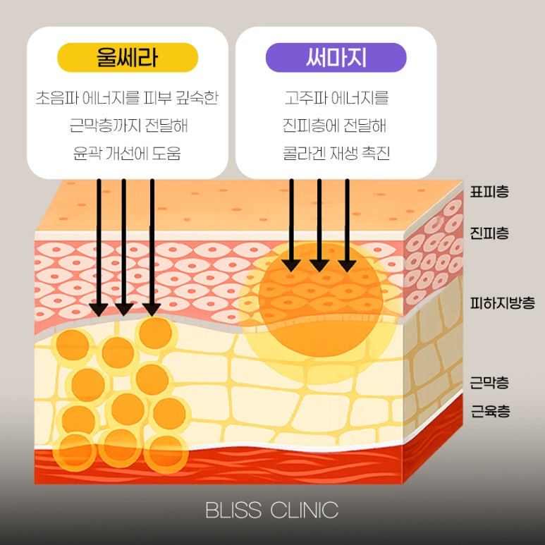 울쎄라와 써마지 조합, 울써마지 가격 및 효과 총정리 관련 이미지 2