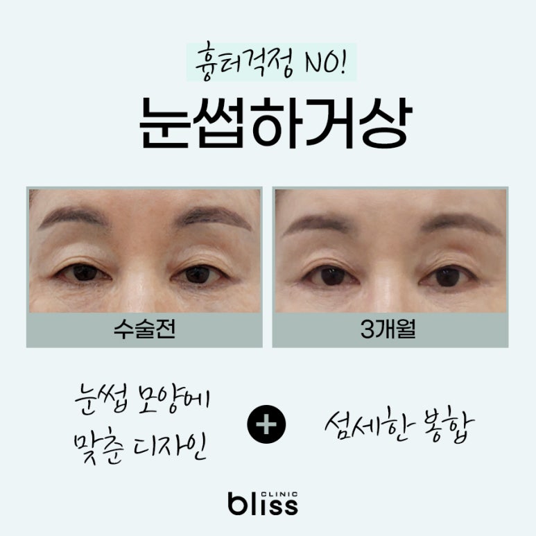 눈썹하거상 가격 흉터 붓기 및 주의사항 관련 이미지 5