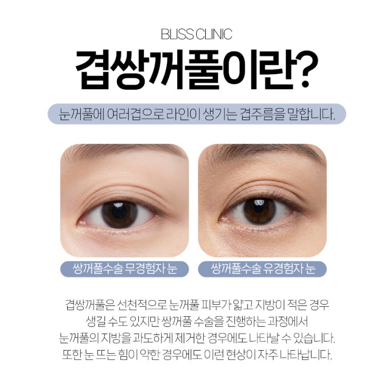 5월 황금연휴, 두세겹으로 보이는 겹쌍꺼풀 교정 블리스에서 관련 이미지 2