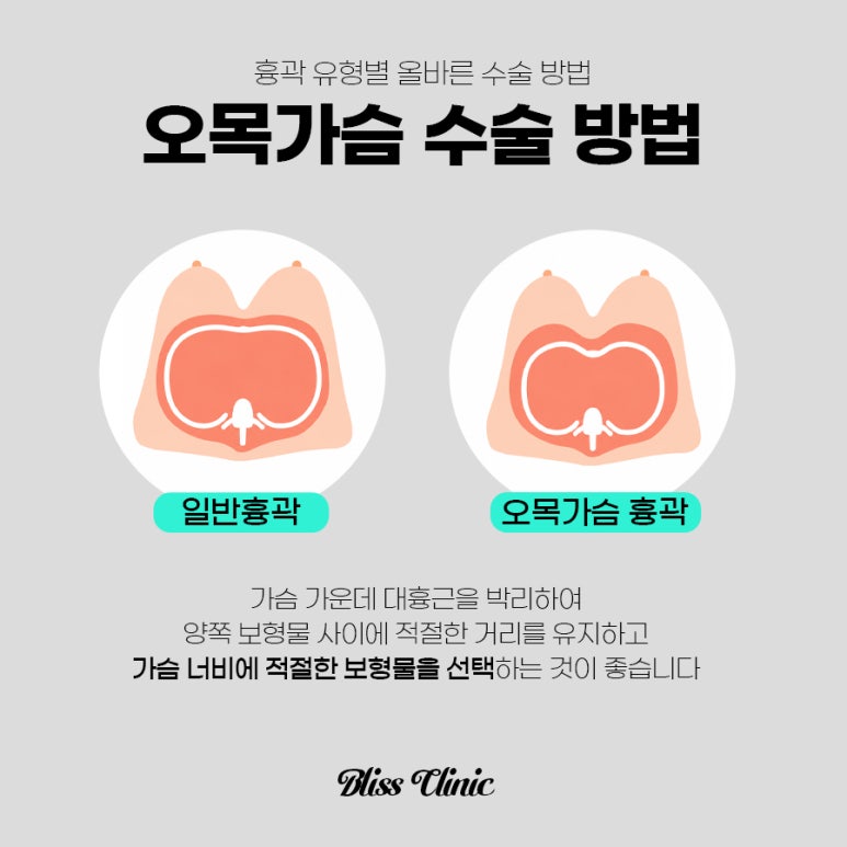 오목가슴 새가슴 성공적인 가슴 성형을 위한 맞춤 솔루션 관련 이미지 4
