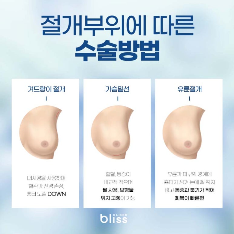 가슴확대 수술방법 절개 부위 흉터, 회복기간 차이 총정리 관련 이미지 3