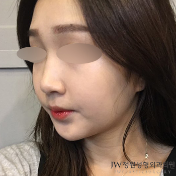 Best Place for Tip Rhinoplasty, See the Natural Results in a Tip Rhinoplasty Review image 1