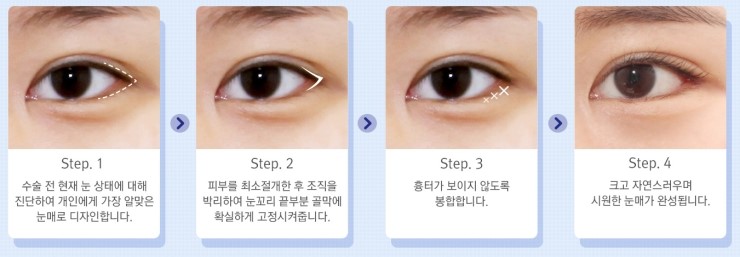 작고 답답한 눈에서 시원시원한 눈으로! JW정원성형외과 트임수술 관련 이미지 9