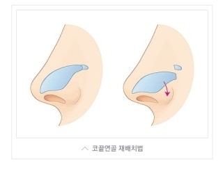 내 얼굴의 중심, 황금비율로! JW정원성형외과 짧은코성형 관련 이미지 7