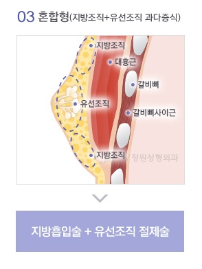 남모를 고민 여성형유방(여유증), JW정원성형외과 여성형유방 수술로 고민해결! 관련 이미지 5