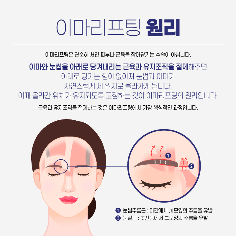 이마거상후기 리프팅으로 쫙 올라간 효과는 관련 이미지 2