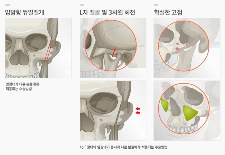 어느 각도에서도 부드럽고 아름다운 얼굴라인! JW정원성형외과 광대축소술로 관련 이미지 3