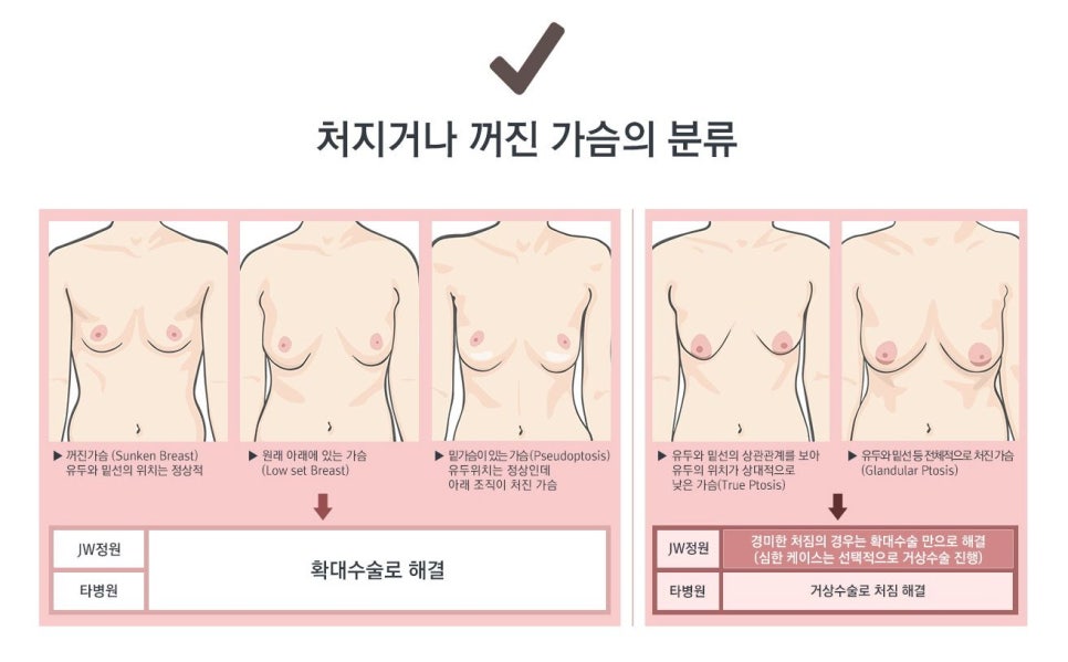 처진정도, 높이, 위치, 비대칭 등을 고려한 JW 처진가슴수술 관련 이미지 2