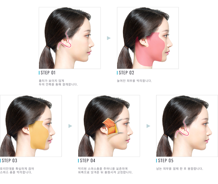 강력한 리프팅 효과로 동안 유지▷▶JW정원성형외과 스마스 조각 리프팅 관련 이미지 7