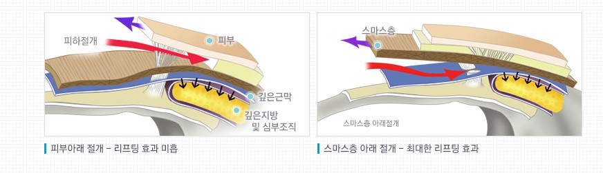 [JW정원 스마스리프팅] 꽃중년 미모의 완성, 스마스리프팅으로 관련 이미지 3
