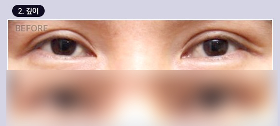 Double Eyelid Line Revision Surgery: Finding a Clinic That Is Good at Eye Revision Surgery image 3