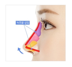 [JW Jeongwon Plastic Surgery] More Professional and Safer Rib Cartilage Rhinoplasty image 8