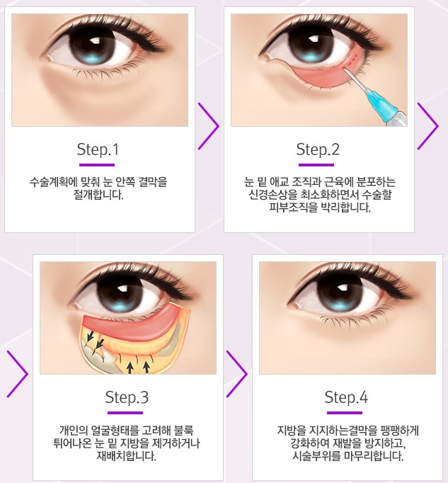 울퉁불퉁한 눈 밑, 피곤해 보이는 눈 밑 JW정원 눈밑지방재배치로 고민 해결! 관련 이미지 8