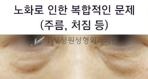 Best Place for Under-Eye Fat Repositioning, with a Surgical Method Suited to My Under-Eyes image 5