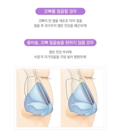 강하고 억센 이미지에서 날렵하고 부드러운 이미지로! JW정원성형외과 매부리코 성형 관련 이미지 3