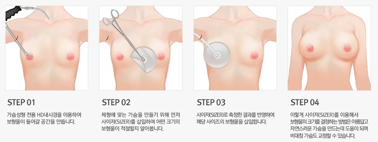 안전하고 정확한 가슴성형 JW정원 HD내시경 가슴확대로 관련 이미지 4