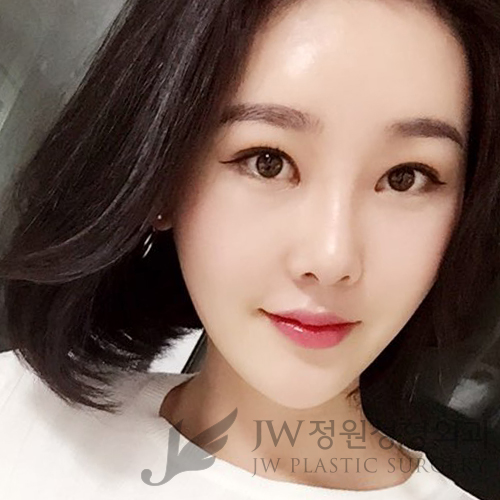 이마눈썹리프팅,눈매교정술,앞트임복원,코성형,지방이식 &rArr; JW정원성형외과에서! 관련 이미지 11