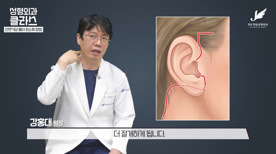 안면거상술후기 흉터 걱정 없이 깔끔하게!  【강남 JW정원성형외과】 관련 이미지 3