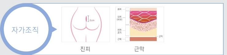 [JW정원성형외과] 코성형, 나에게 적합한 보형물은? 관련 이미지 3