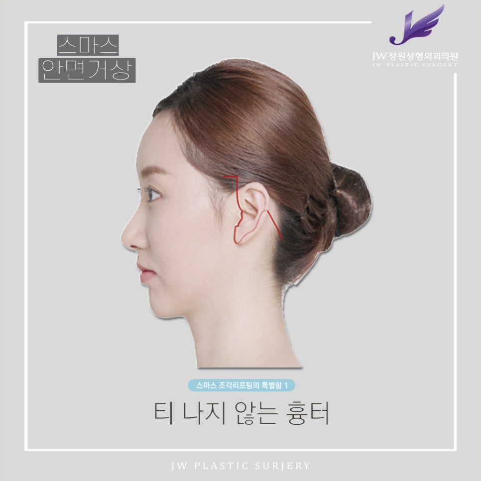SMAS Facelift!? Just Right for Facial Wrinkle Lifting! image 7