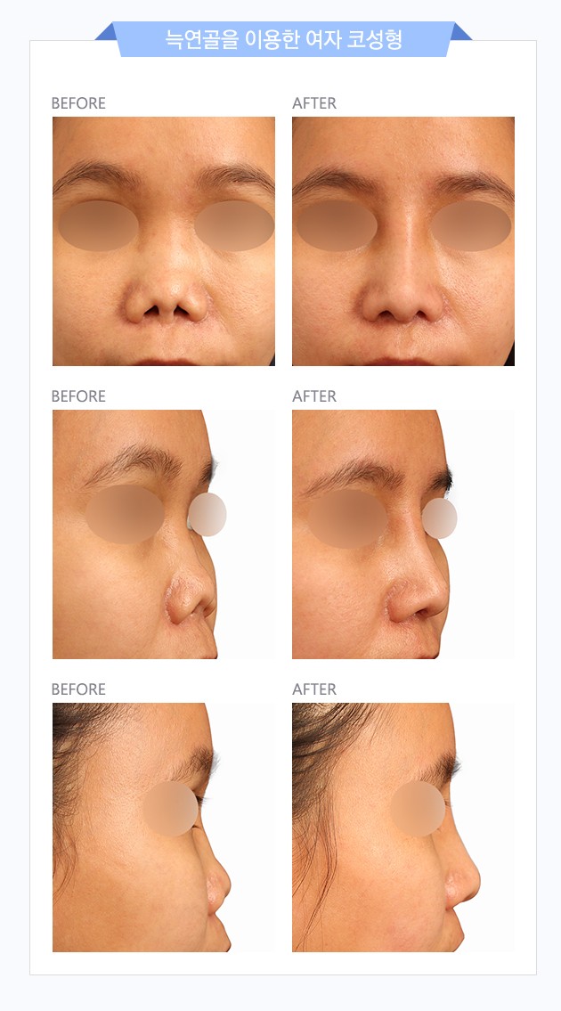 Silicone Side Effects: Safe and Beautiful Revision Rhinoplasty with Autologous Rib Cartilage! image 5