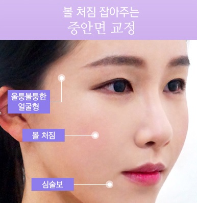 뼈 수술 없이 매끄러운 브이라인얼굴! JW정원성형외과 윤곽교정 관련 이미지 3