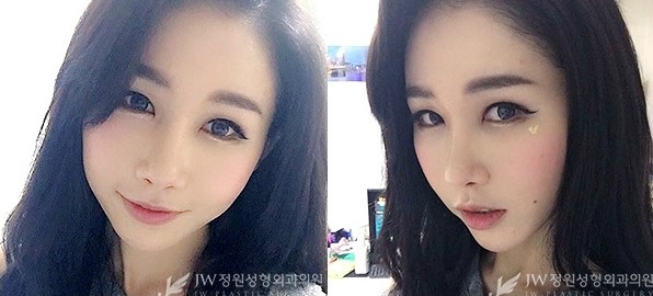 매끈한 콧날과 완벽브이라인 ▶ JW정원성형외과에서!!! 관련 이미지 5