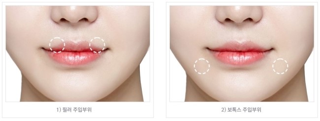 매력적인 입매를 완성하는 JW정원성형외과 입꼬리성형 관련 이미지 3