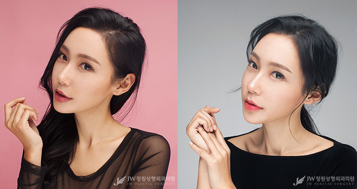[JW정원성형외과] 턱끝재수술, 비절개눈매교정으로 동안 완성♡ 리얼셀카 관련 이미지 8