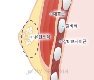 [JW정원성형외과]여유증, 여성형유방 수술로 해결하세요! 관련 이미지 5