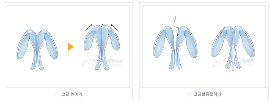 코끝에서 완성되는 아름다움, JW정원성형외과 코끝성형 관련 이미지 4