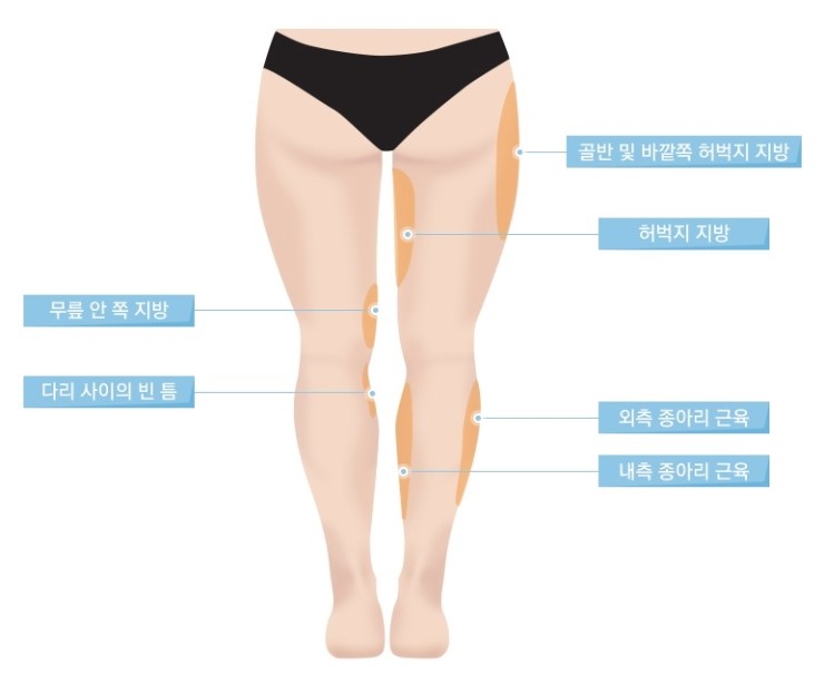JW정원성형외과 체형성형▷모델핏다리교정∬ 관련 이미지 2