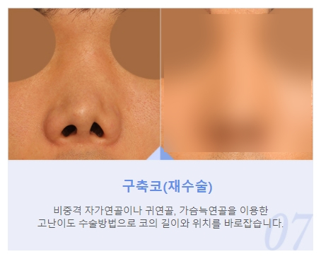 JW Male Rhinoplasty for a Refined Straight Line image 7