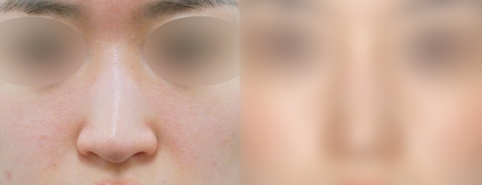 비중격만곡증 수술후기 아름다운 코라인까지 관련 이미지 6