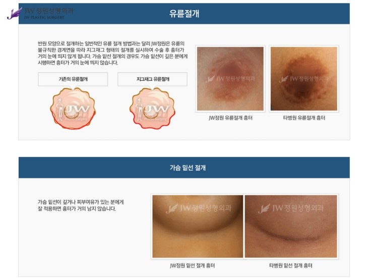 [JW정원성형외과] 가슴보형물 + 가슴지방이식 장점을 담은 콤비네이션 가슴확대성형 관련 이미지 9