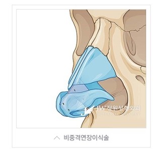 내 얼굴의 중심, 황금비율로! JW정원성형외과 짧은코성형 관련 이미지 3