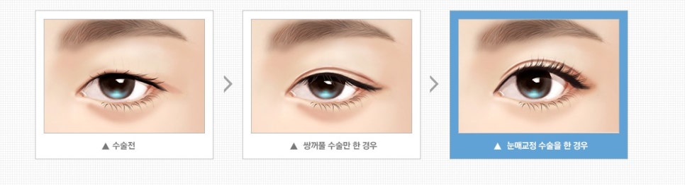 Ptosis Double Eyelid Surgery: Different Eye-Correction Methods Depending on the Degree image 2