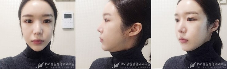 [JW정원성형외과] 지방이식+코재수술로 입체감 있는 얼굴완성♡ 관련 이미지 4